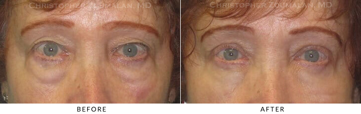 Quad Blepharoplasty Before & After Photo -  - Patient 52