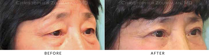 Quad Blepharoplasty Before & After Photo - Patient Seeing Side - Patient 57B