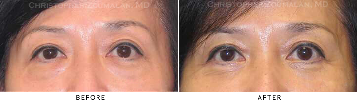 Quad Blepharoplasty Before & After Photo - Patient Seeing Straight - Patient 58A