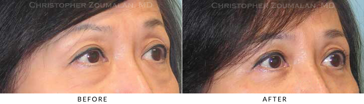 Quad Blepharoplasty Before & After Photo - Patient Seeing Side - Patient 58B