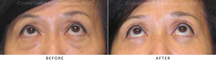 Quad Blepharoplasty Before & After Photo - Patient Seeing Up - Patient 58C