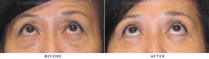 Quad Blepharoplasty Before & After Photo - Patient Seeing Up - Patient 58C