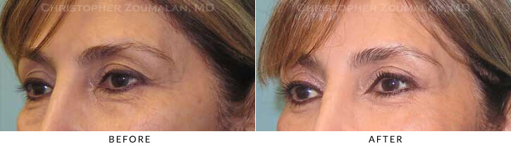 Quad Blepharoplasty Before & After Photo - Patient Seeing Side - Patient 59B