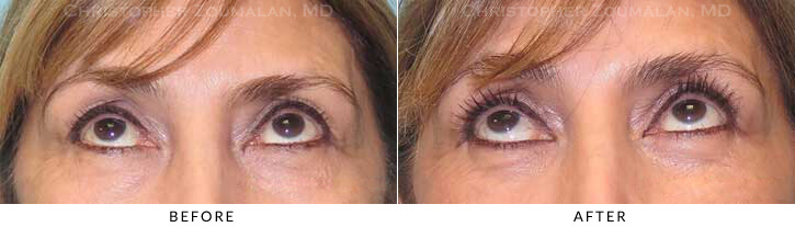 Quad Blepharoplasty Before & After Photo - Patient Seeing Up - Patient 59C