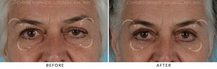 Quad Blepharoplasty Before & After Photo - Patient Seeing Straight - Patient 14A