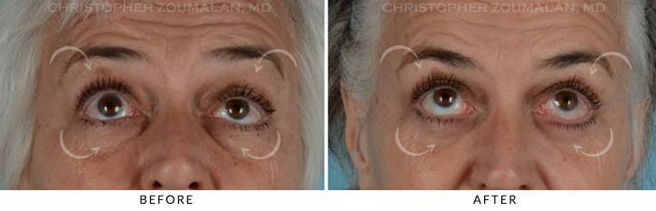 Quad Blepharoplasty Before & After Photo - Patient Seeing Up - Patient 10B