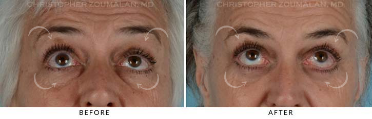 Quad Blepharoplasty Before & After Photo - Patient Seeing Up - Patient 14B