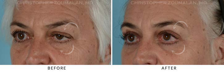 Quad Blepharoplasty Before & After Photo - Patient Seeing Side - Patient 14C