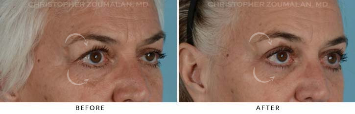 Quad Blepharoplasty Before & After Photo - Patient Seeing Side - Patient 14D