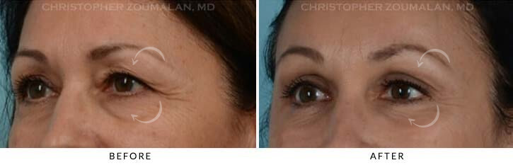 Quad Blepharoplasty Before & After Photo - Patient Seeing Side - Patient 15A