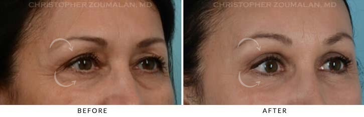 Quad Blepharoplasty Before & After Photo - Patient Seeing Side - Patient 15B