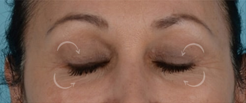 Quad Blepharoplasty Before & After Photo - Patient with Eyes Closed - Patient 15C