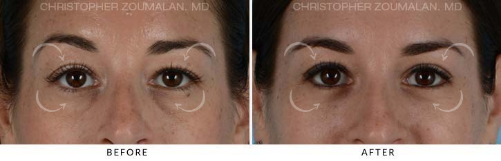 Quad Blepharoplasty Before & After Photo - Patient Seeing Straight - Patient 16A