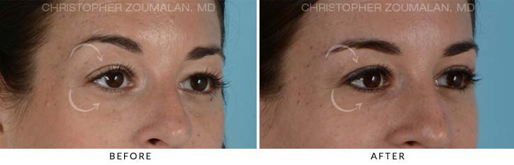 Quad Blepharoplasty Before & After Photo - Patient Seeing Side - Patient 16B