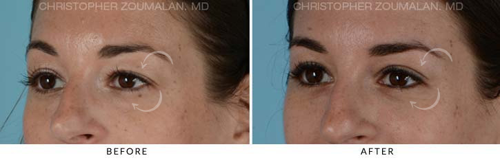 Quad Blepharoplasty Before & After Photo - Patient Seeing side - Patient 16C