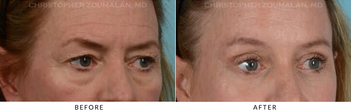 Quad Blepharoplasty Before & After Photo - Patient Seeing Side - Patient 17B