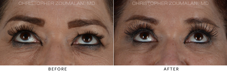 Quad Blepharoplasty Before & After Photo - Patient Seeing Up - Patient 18B