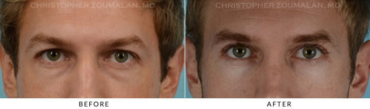 Quad Blepharoplasty Before & After Photo - Patient Seeing Straight - Patient 19A