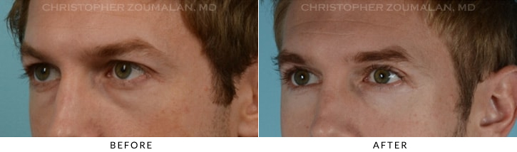 Quad Blepharoplasty Before & After Photo - Patient Seeing Side - Patient 19B