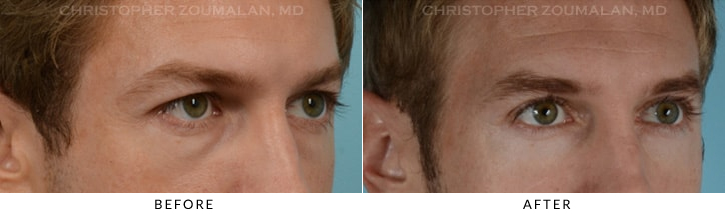 Quad Blepharoplasty Before & After Photo - Patient Seeing Side - Patient 19C