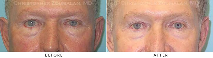 Revisional Eyelid Surgery Before & After Photo -  - Patient 4