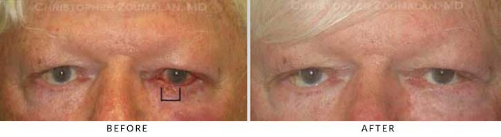 Eyelid Skin Cancer Excision Before & After Photo - Patient Seeing Straight - Patient 1A