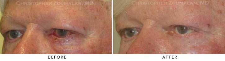 Eyelid Skin Cancer Excision Before & After Photo - Patient Seeing Side - Patient 1B