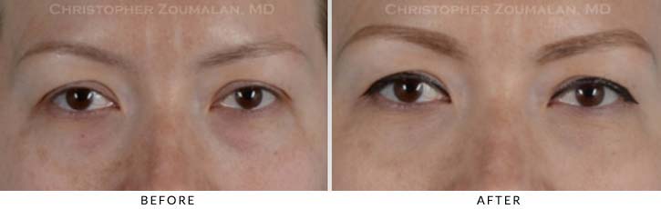 Tear Duct Surgery Before & After Photo - Patient Seeing Straight - Patient 1A