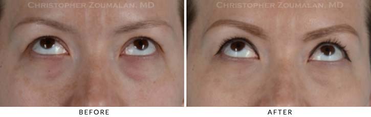 Tear Duct Surgery Before & After Photo - Patient Seeing Up - Patient 1B