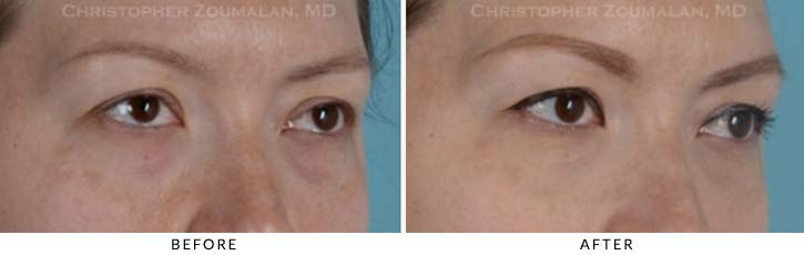 Tear Duct Surgery Before & After Photo - Patient Seeing Side - Patient 1C