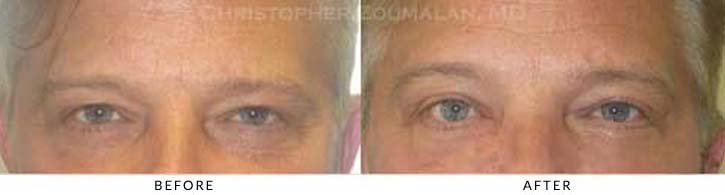 Tear Duct Surgery Before & After Photo - Patient Seeing Straight - Patient 2A