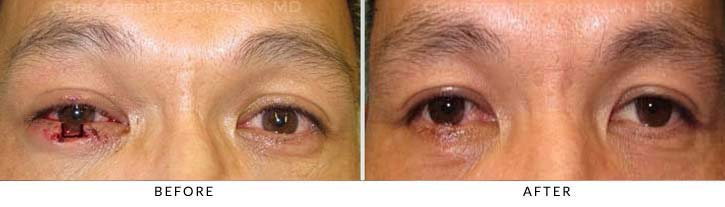 Preoperative photo shows a full-thickness eyelid laceration of the right lower lid- female patient before and after picture