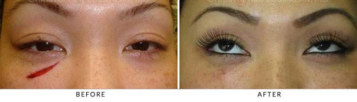 This patient’s dog accidentally bit her eyelid. Fortunatley, the eye and the tear duct system were uninjured - female patient before and after picture