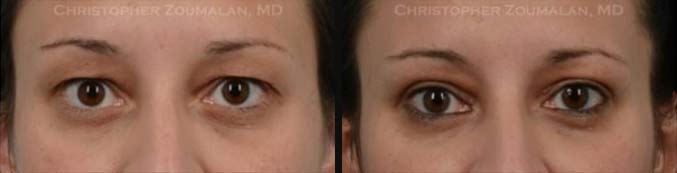 Upper Eyelid Blepharoplasty Front Side