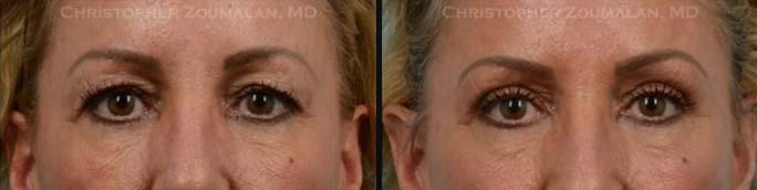 Upper Eyelid Blepharoplasty Front