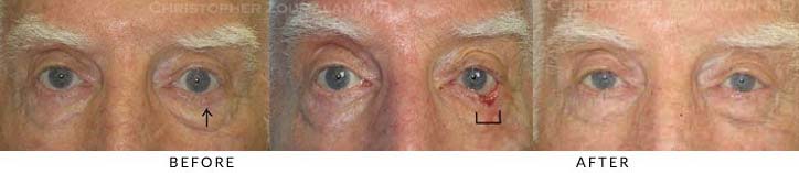 Eyelid Skin Cancer Excision Before & After Photo - Patient Seeing Straight - Patient 10