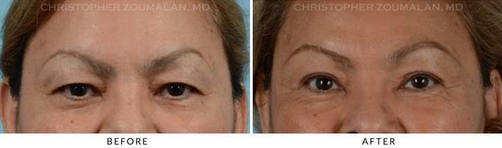 Upper Lid Blepharoplasty Before & After Photo - Patient Seeing Straight - Patient 25A