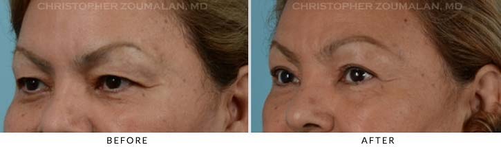 Upper Lid Blepharoplasty Before & After Photo - Patient Seeing Side - Patient 25B