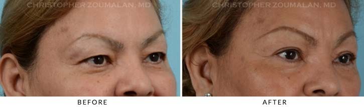 Upper Lid Blepharoplasty Before & After Photo - Patient Seeing side - Patient 25C