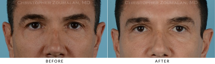 Upper Lid Blepharoplasty Before & After Photo - Patient Seeing Straight - Patient 26A