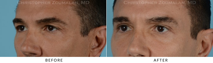 Upper Lid Blepharoplasty Before & After Photo - Patient Seeing Side - Patient 26B