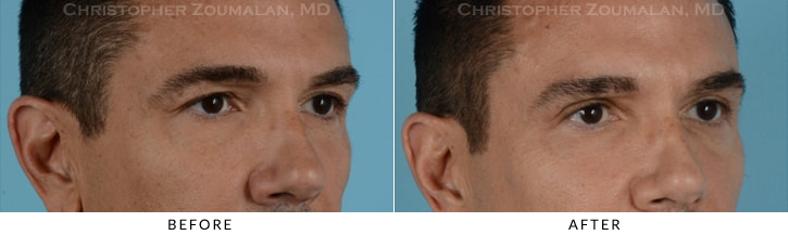 Upper Lid Blepharoplasty Before & After Photo - Patient Seeing Side - Patient 26C