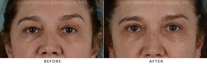 Upper Lid Blepharoplasty Before & After Photo -  - Patient 27
