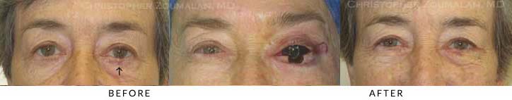 Eyelid Skin Cancer Excision Before & After Photo - Patient Seeing Straight - Patient 13