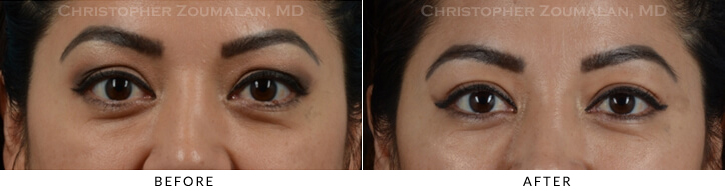 Upper Lid Blepharoplasty Before & After Photo - Patient Seeing Straight - Patient 29