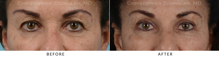 Upper Lid Blepharoplasty Before & After Photo - Patient Seeing Straight - Patient 31A