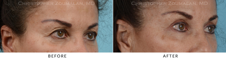 Upper Lid Blepharoplasty Before & After Photo -  - Patient 31B