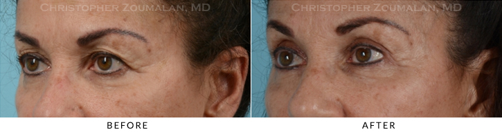 Upper Lid Blepharoplasty Before & After Photo - Patient Seeing Side - Patient 31C