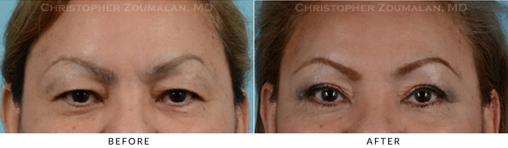 Upper Lid Blepharoplasty Before & After Photo - Patient Seeing Straight - Patient 32A