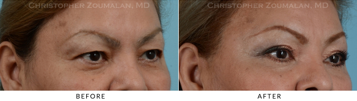 Upper Lid Blepharoplasty Before & After Photo -  - Patient 32B